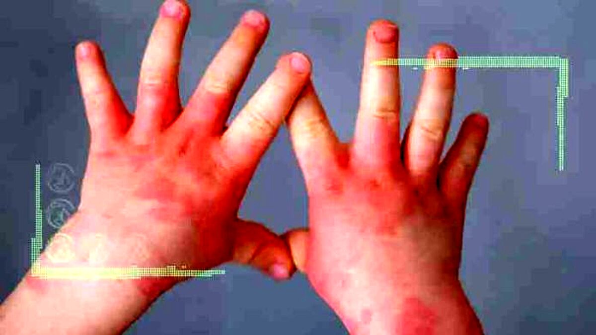 همه چیز درباره تب گوجه‌ فرنگی