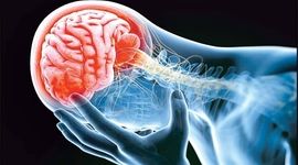سکته مغزی چیست؟ چه علائم و درمان‌هایی دارد؟

